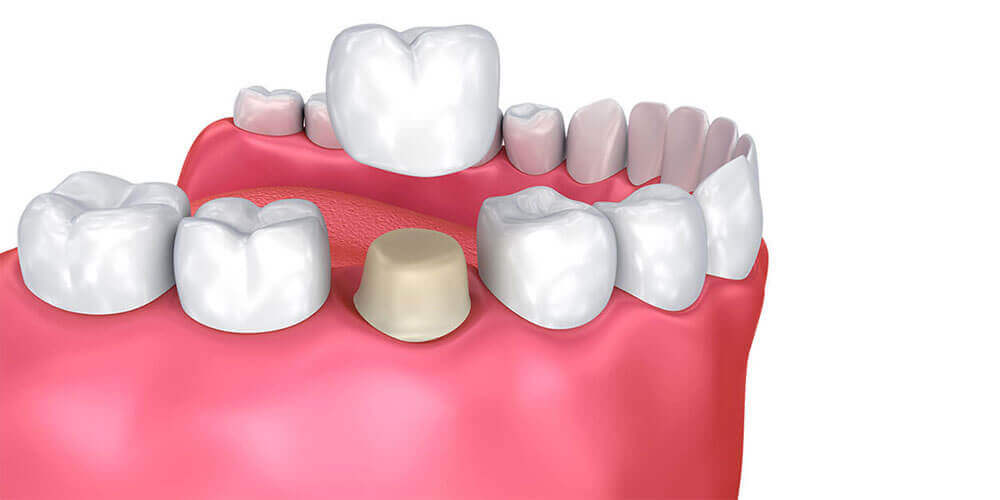 Dental Crowns